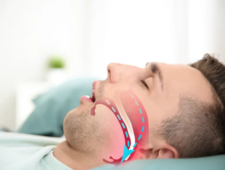 Dr. Marvizi sleep apnea treatment