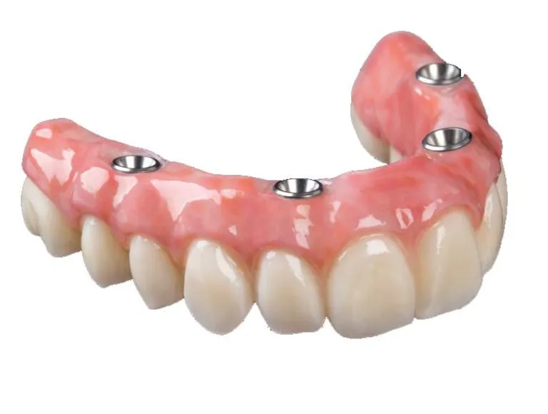 Implant retained dentures Bakersfield