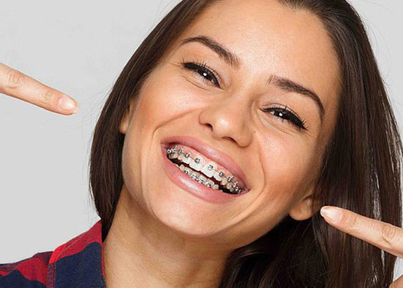 Metal Braces Bakersfield