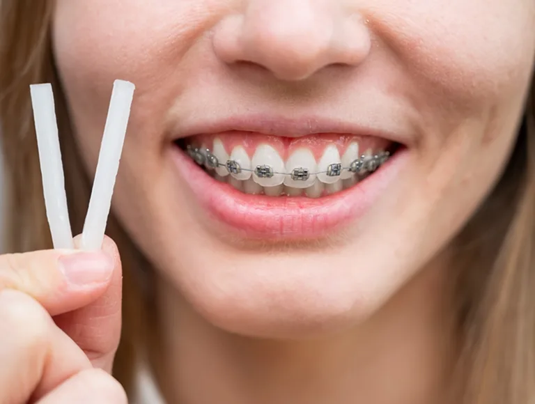 Traditional metal braces Bakersfield